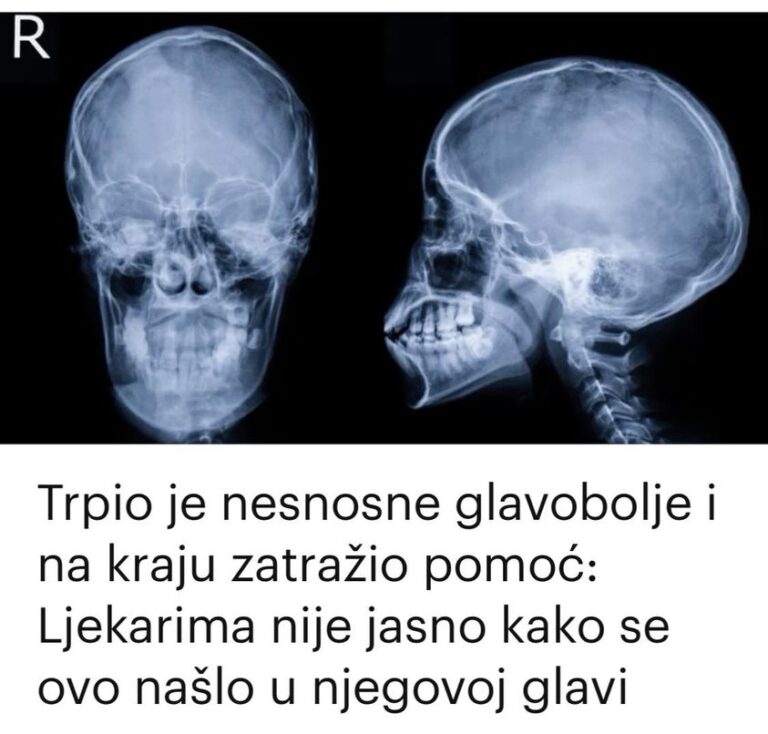 Trpio je nesnosne glavobolje i na kraju zatražio pomoć: Ljekarima nije jasno kako se ovo našlo u njegovoj glavi