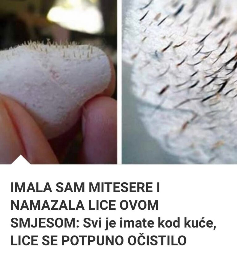 IMALA SAM MITESERE I NAMAZALA LICE OVOM SMJESOM: Svi Je Imate Kod Kuće, LICE SE POTPUNO OČISTILO