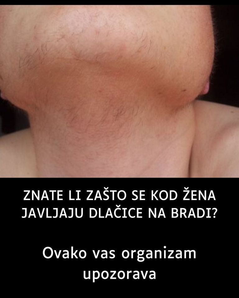 ZNATE LI ZAŠTO SE KOD ŽENA JAVLJAJU DLAČICE NA BRADI? Evo šta je uzrok dlakavosti lica kod žena