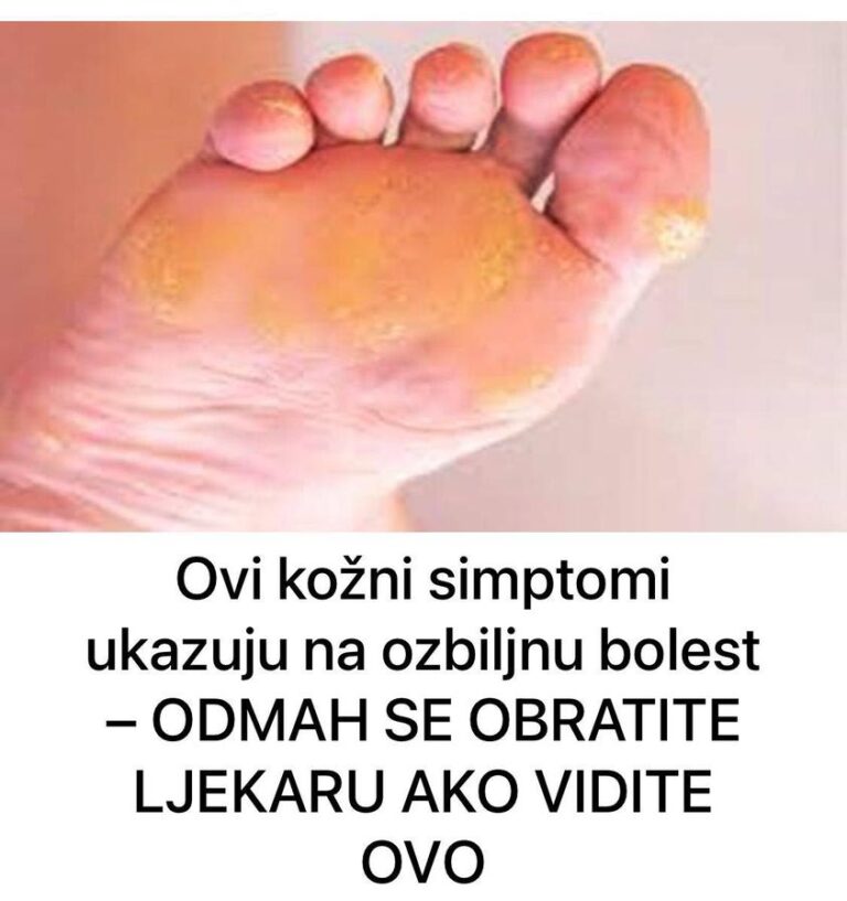 Ovi kožni simptomi ukazuju na ozbiljnu bolest – ODMAH SE OBRATITE LJEKARU AKO VIDITE OVO