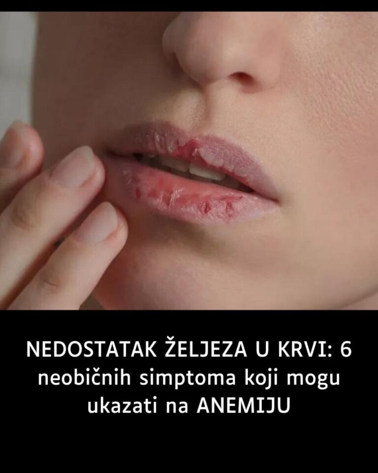 NEDOSTATAK ŽELJEZA U KRVI: 6 neobičnih simptoma koji mogu ukazati na ANEMIJU