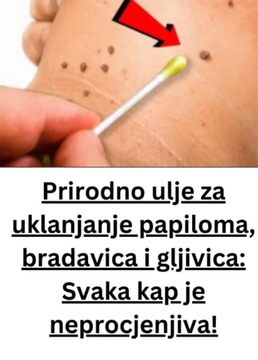 Prirodno ulje za uklanjanje papiloma, bradavica i gljivica: Svaka kap je neprocjenjiva!