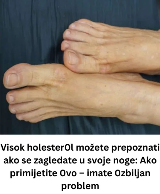 Visok holester0l možete prepoznati ako se zagledate u svoje noge: Ako primijetite 0vo – imate 0zbiljan problem