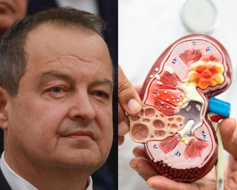Ivica Dačić ne boluje samo od upale pluća, ovu bolest je ignorisao godinama, a tiho razara sve organe: Srbi je zanemaruju dok stanje ne postane opasno