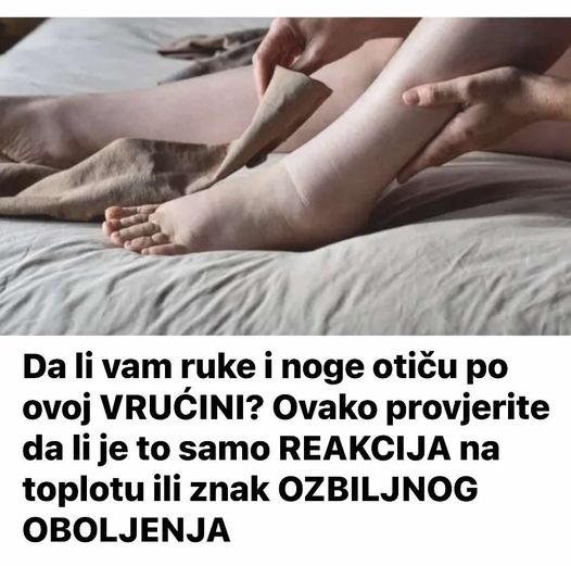 Da li vam ruke i noge otiču po ovoj vrućini? Ovako provjerite da li je to samo REAKCIJA na toplotu ili znak OZBILJNOG OB0LJENJA