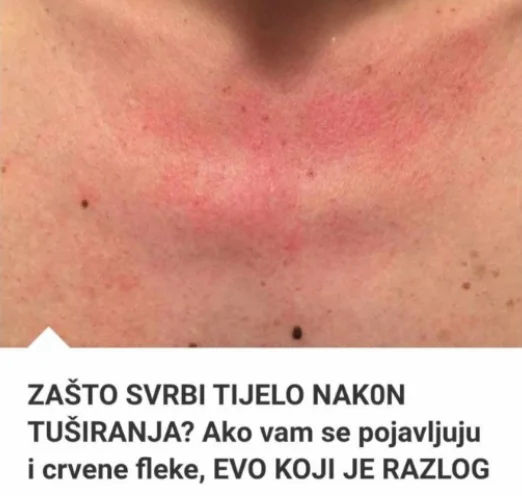 Zašto me tijelo svrbi nakon tuširanja Ako i vi imate crvene mrlje, evo zašto..