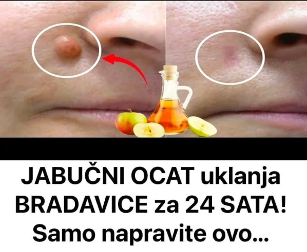 JABUČNI 0CAT uklanja BRADAVICE za 24 SATA! Samo napravite ovo…