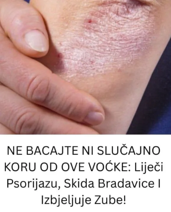 NE BACAJTE NI SLUČAJNO KORU OD OVE VOĆKE: Liječi Psorijazu, Skida Bradavice I Izbjeljuje Zube!